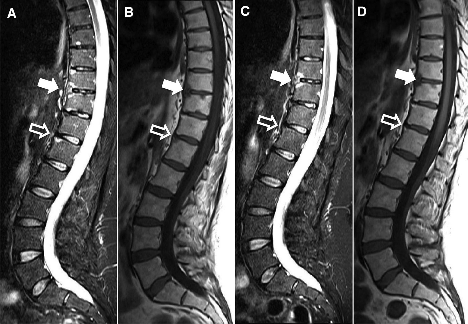 Vertebral Erosions Associated with Spinal Inflammation in Patients with  Ankylosing Spondylitis Identified by Magnetic Resonance Imaging: Changes  After 2 Years of Tumor Necrosis Factor Inhibitor Therapy | The Journal of  Rheumatology